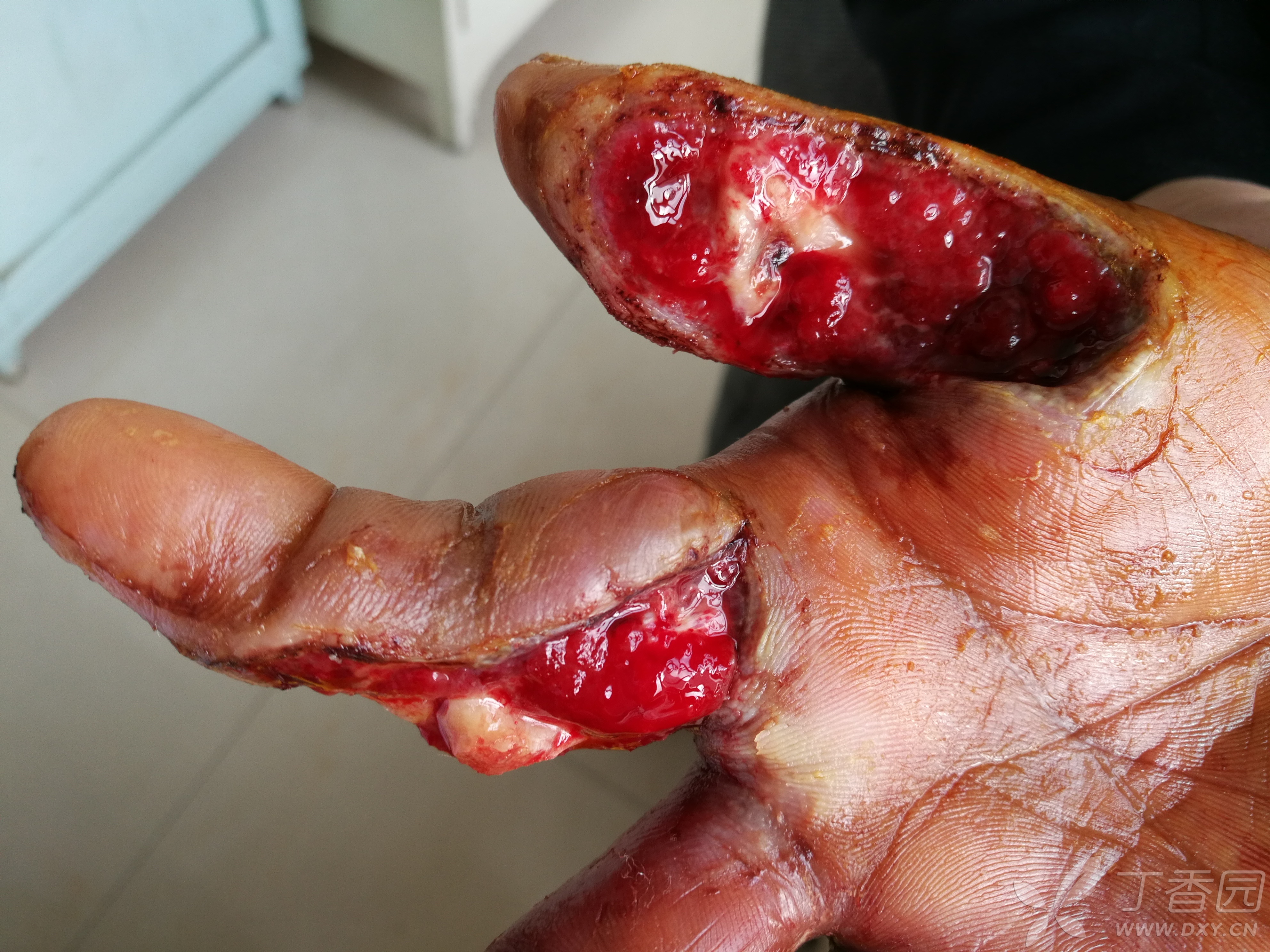 岁 简要病史:3周前右手拇,食指被玉米剥皮机挤压伤,伤后在外院行清创