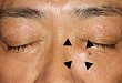 疾病追凶：面部肿物源于 30 年前的一次手术