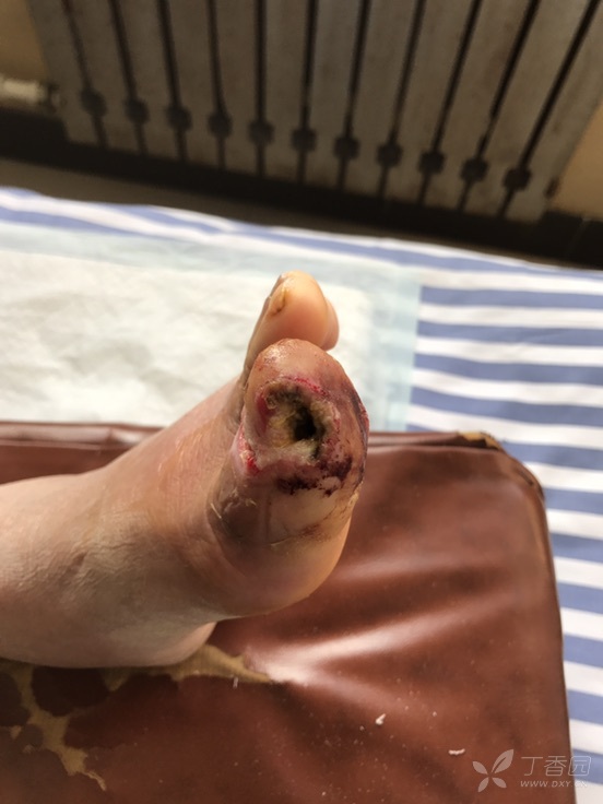 足踇趾末节骨髓炎!