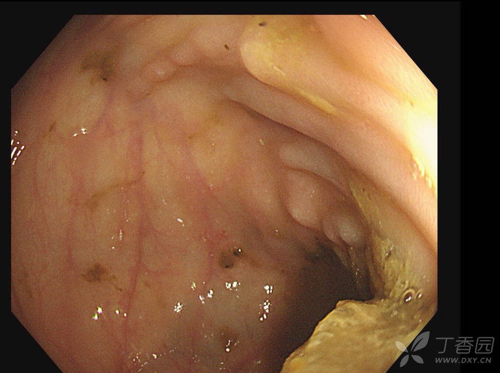 串珠样改变的粘膜隆起