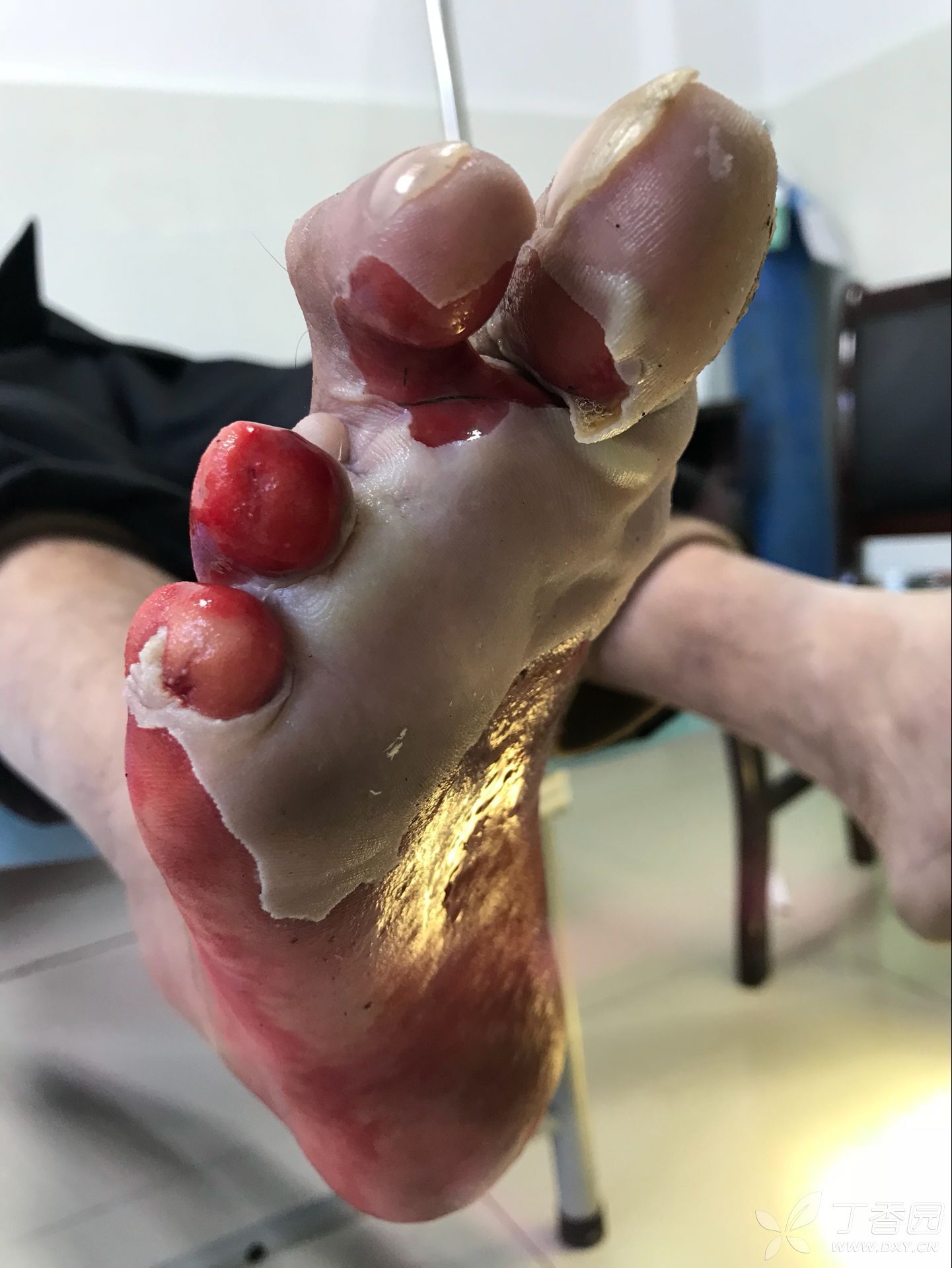 右足全皮剥脱,求助!