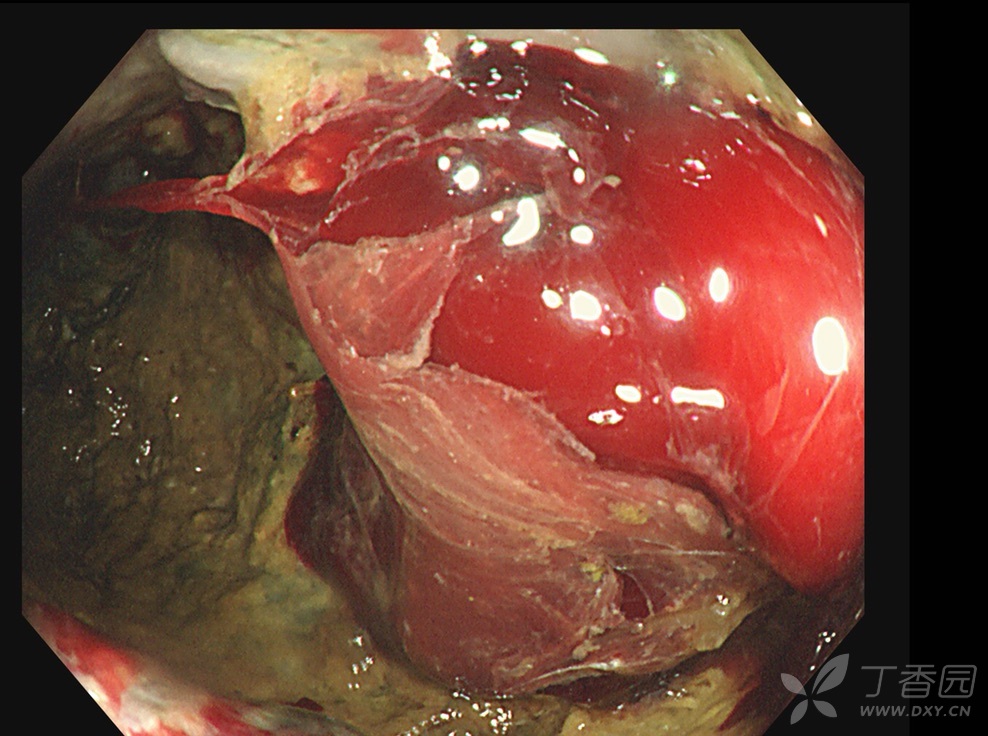 串珠样改变的粘膜隆起