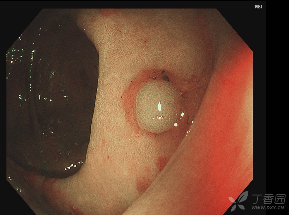 串珠样改变的粘膜隆起