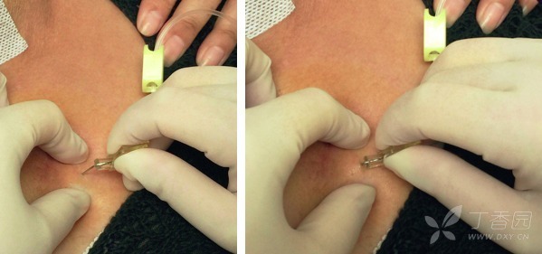 穿刺:触诊定位穿刺隔,一手找到输液港注射座的位置,拇指与食指,种指