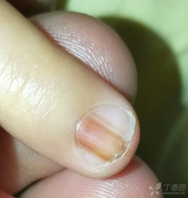 正常人指甲有竖条纹吗 3240603670808171313-16w.jpg!w640