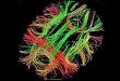 抗 NMDA 受体脑炎：脑神经网络的功能性连接分析
