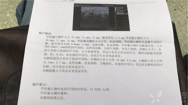 甲状腺治疗排名医院_甲状腺结节图片(2)