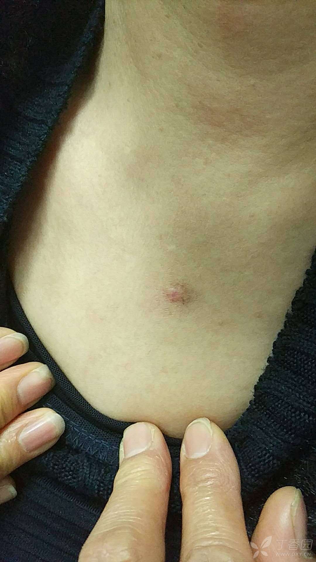 锁骨下皮肤丘疹,有痒感,做了个病理,大家帮我看看啥情况,怎么治疗?