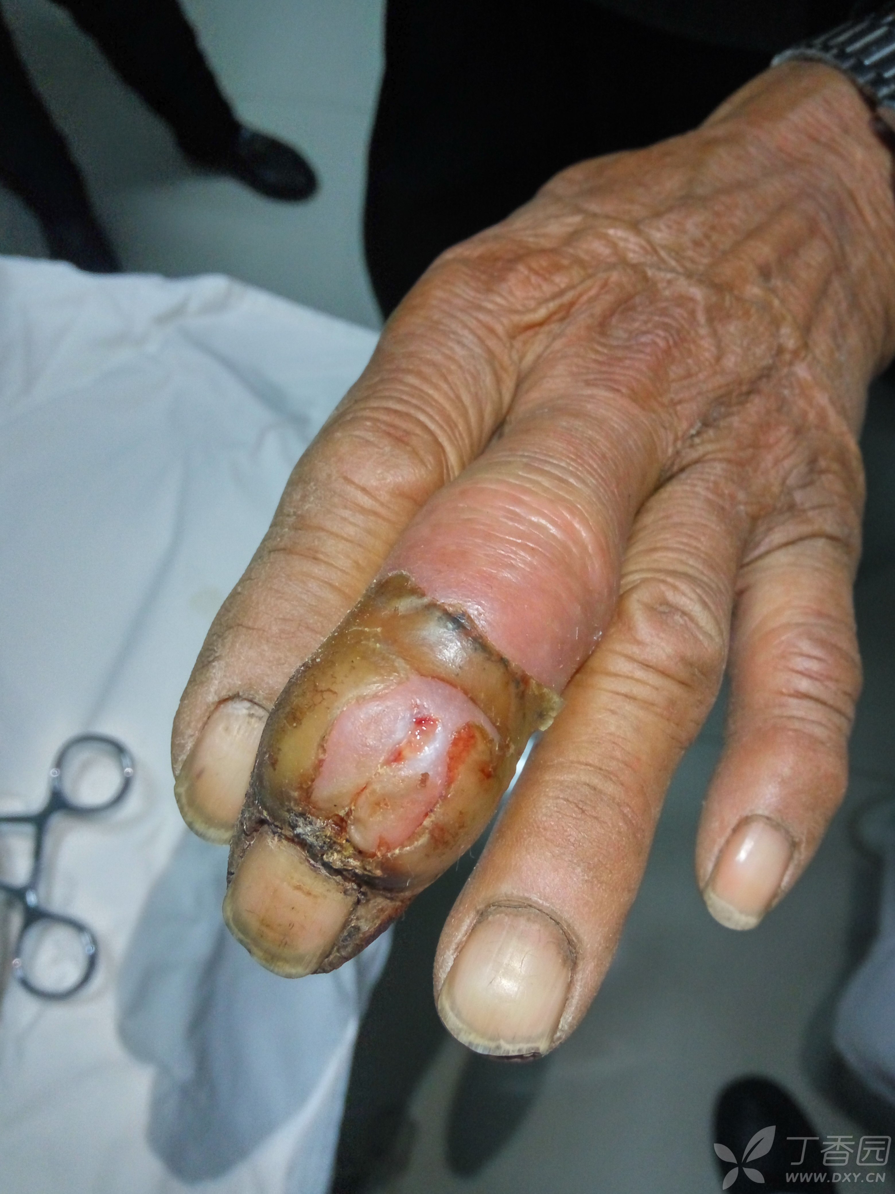 肺癌手指图片