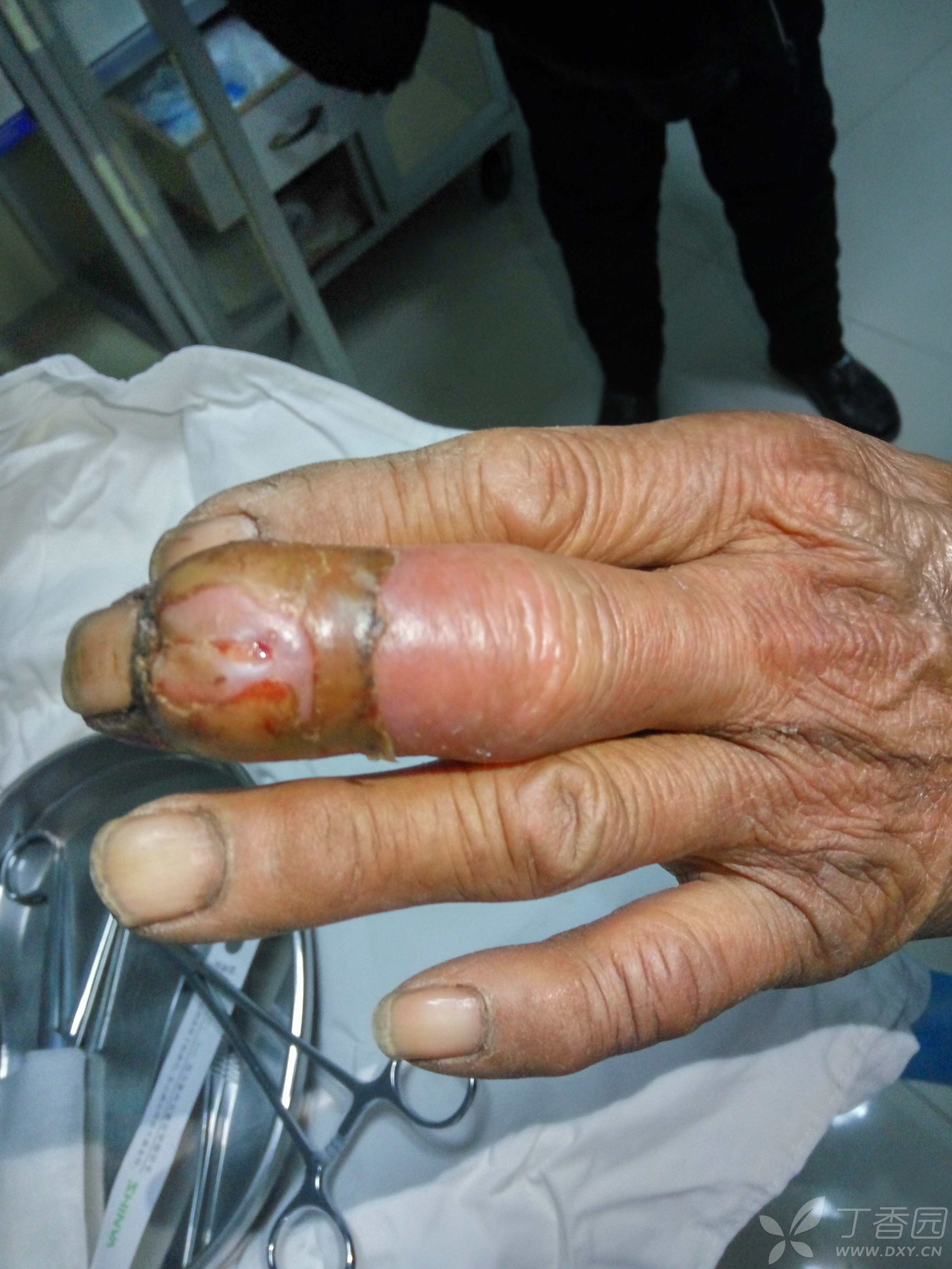 手指癌图片图片