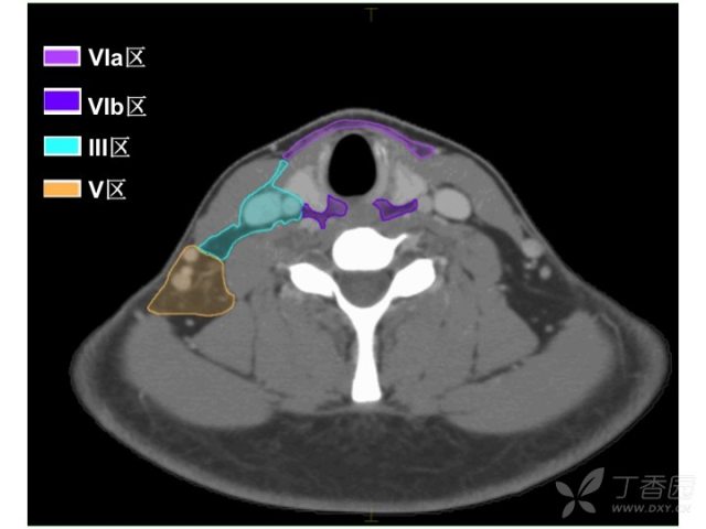 颈部ct横断面解剖图谱图片