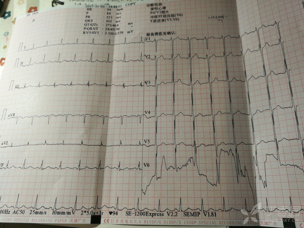 ptfv1阳性有何意义