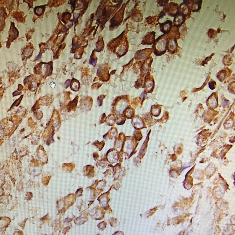 黑色素瘤细胞形态图片