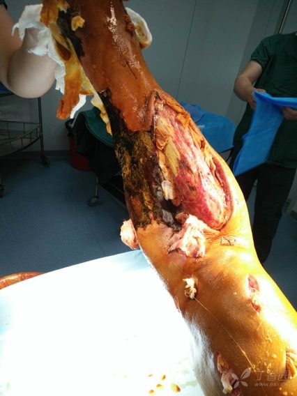 患者 男 67 机器绞伤左小腿4小时 以胫骨近端开放性骨折收入院.