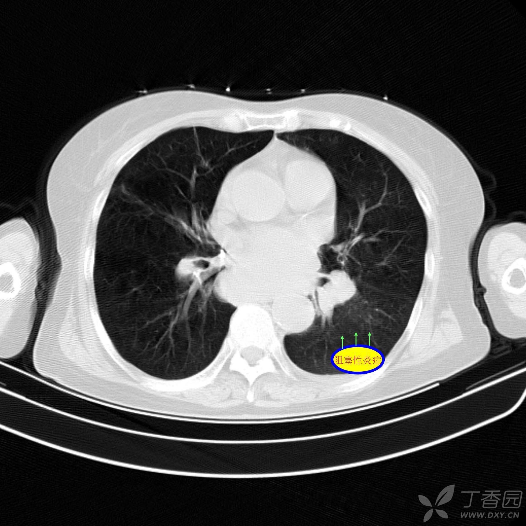 肿瘤片子图片