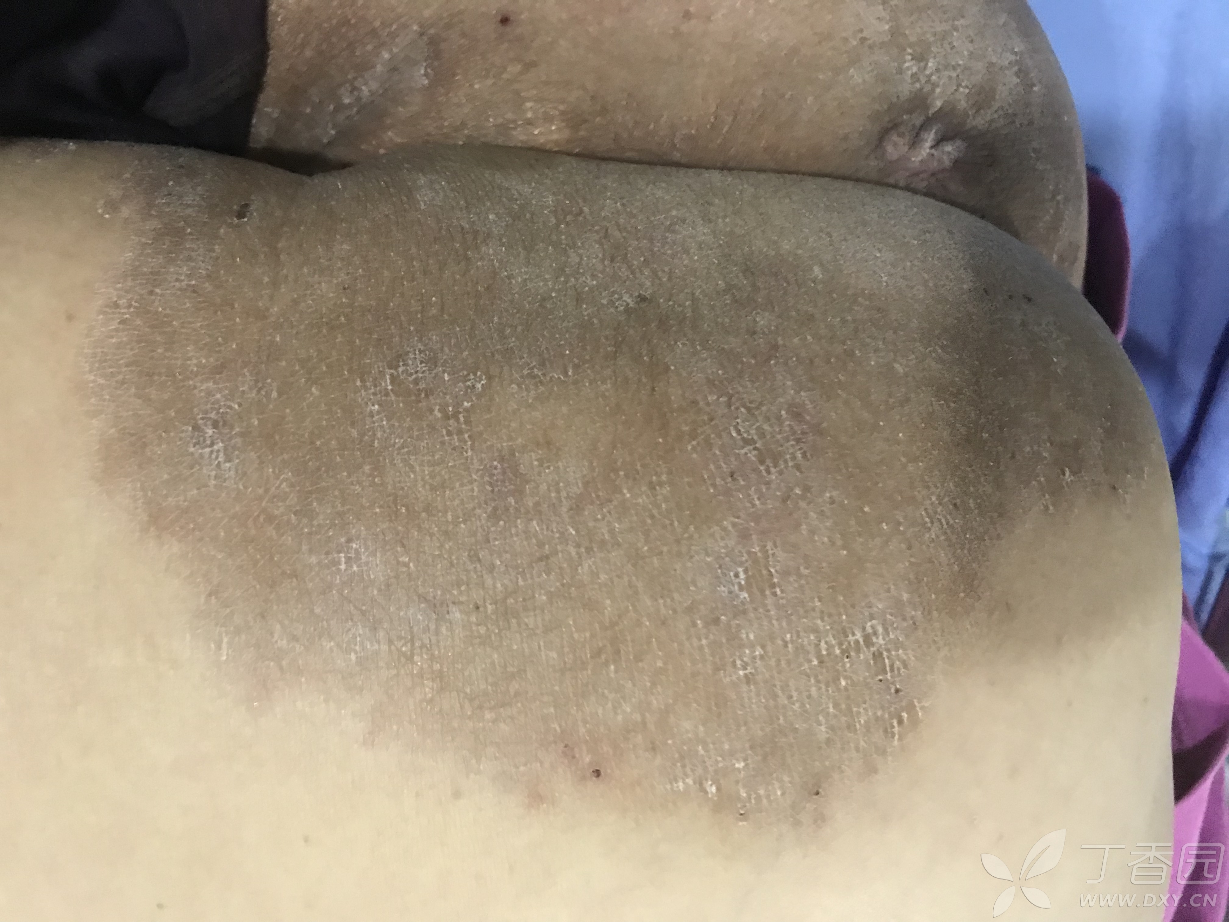 20余年腹股沟及臀部皮肤病