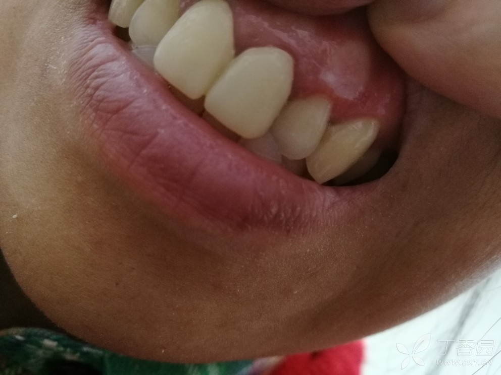 牙龈白斑癌变图片