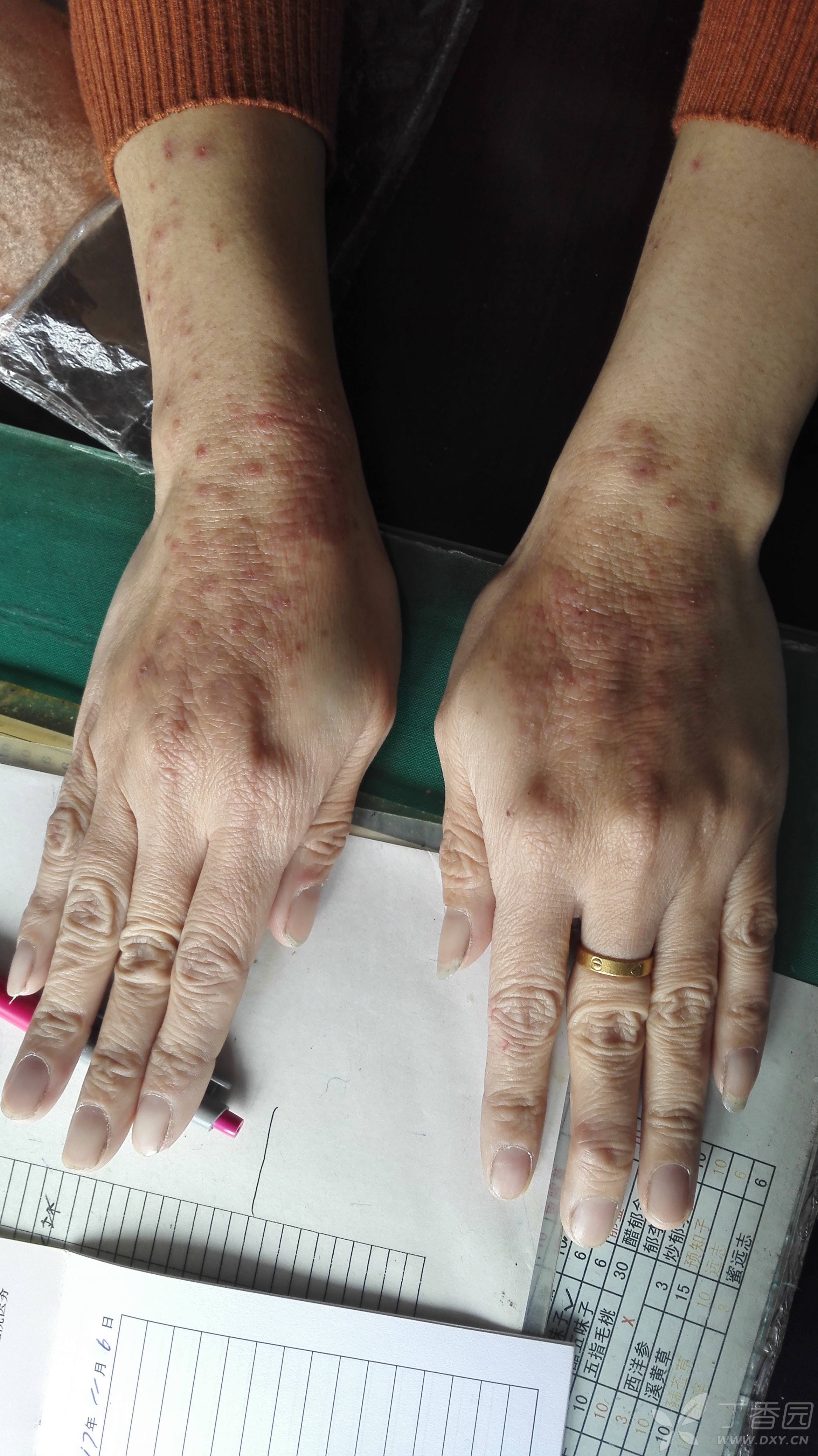 慢性湿疹六年 - 皮肤性病 -丁香园论坛