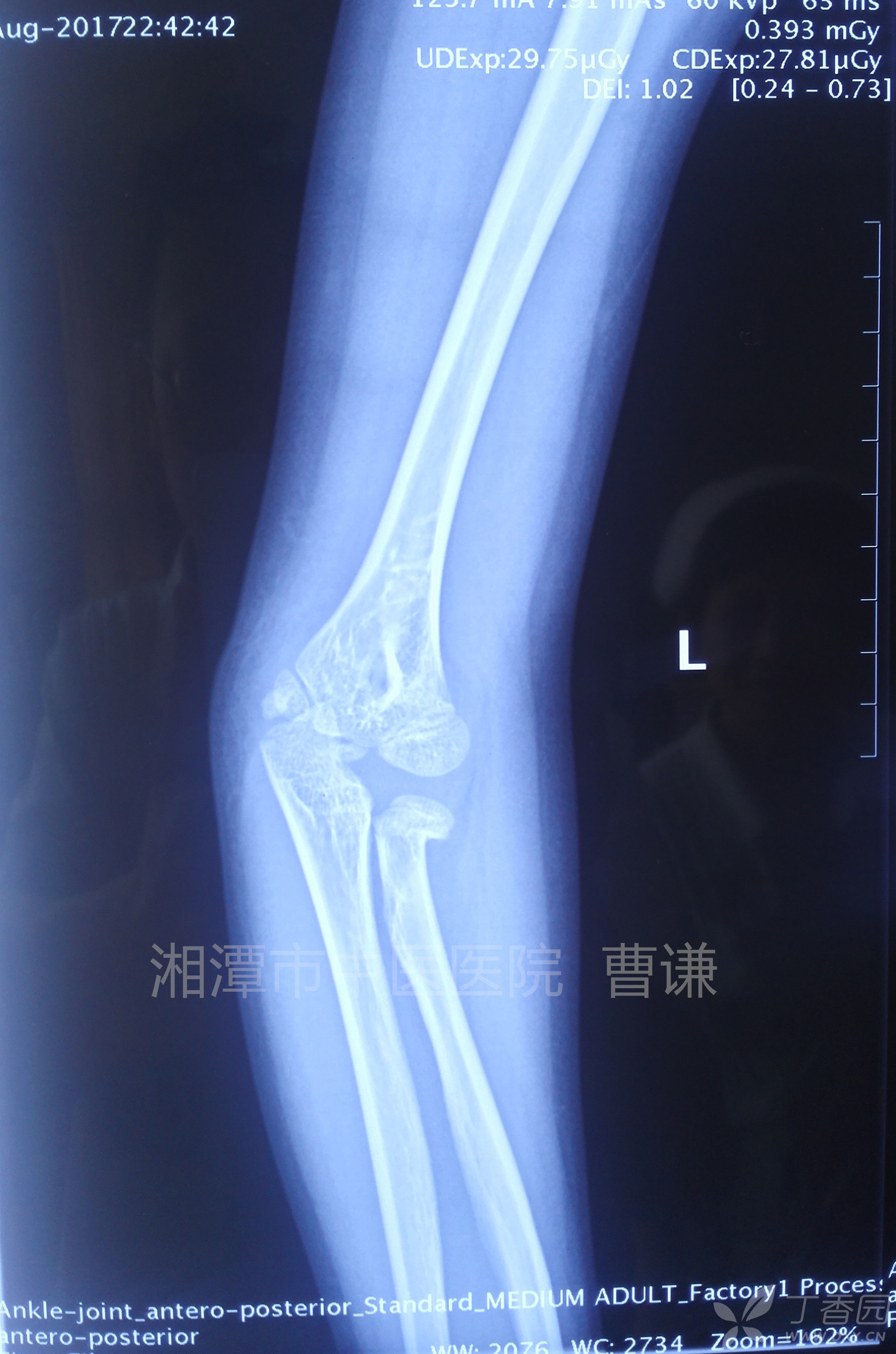 简要病史:患者滑冰时跌倒致左肘部肿痛,活动受限,在外院行拍片及ct