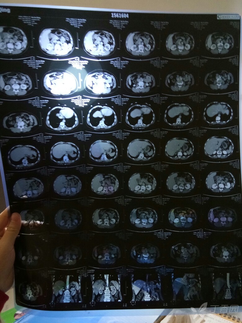 这个是小肝ca 吗?