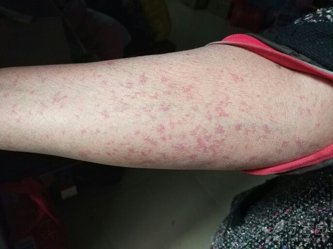 过敏性紫癜治疗