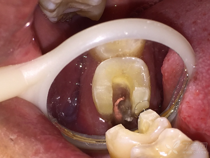 患者男性37岁,下7牙髓炎,看片子很像2个牙根,开髓后清晰见c型根管,热