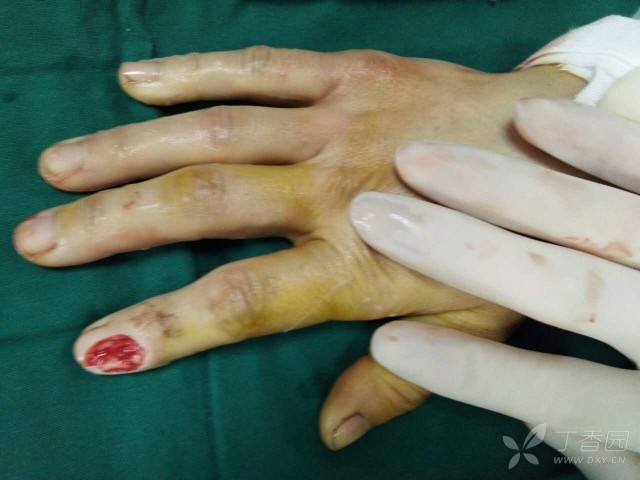 指端缺损小皮瓣修复 [病例帖]