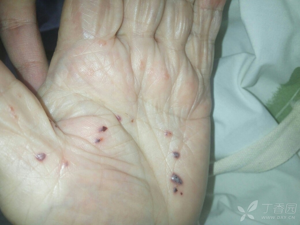 80岁女性,有糖尿病,血糖控制很好,最近两天发现双手手掌出现水泡样的