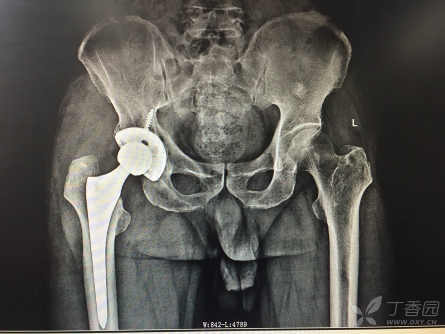 自己做的第一例全髋,请大家指点 [病例帖]