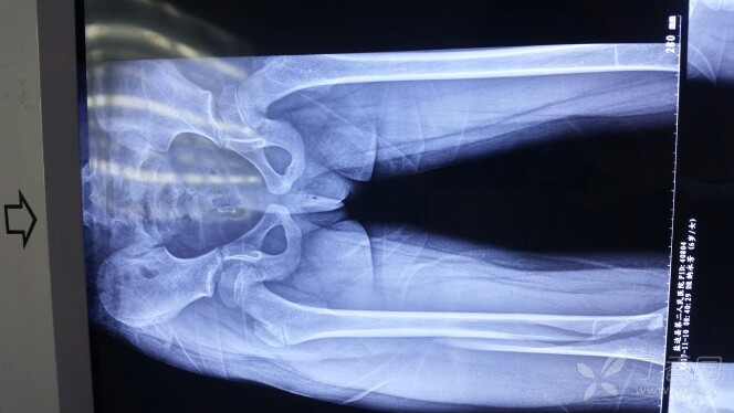 6岁小孩股骨干下段骨折的治疗 [病例帖]