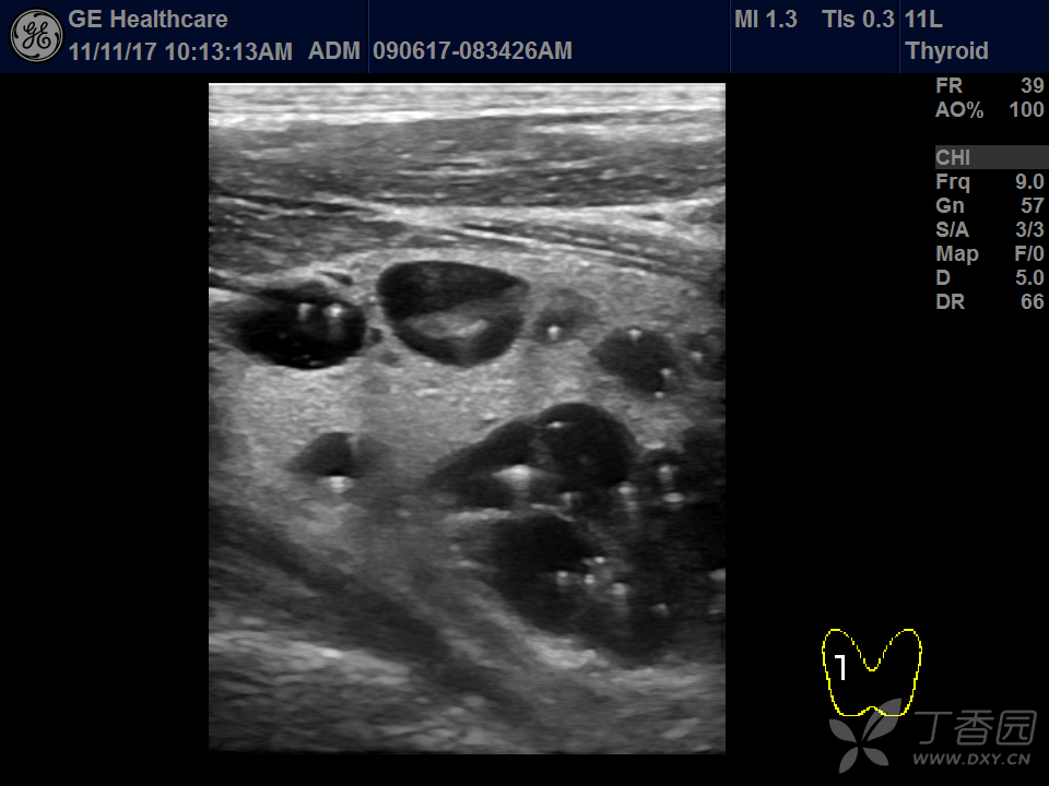 甲状腺浓缩胶质经典图谱 - 超声医学 -丁香园论坛