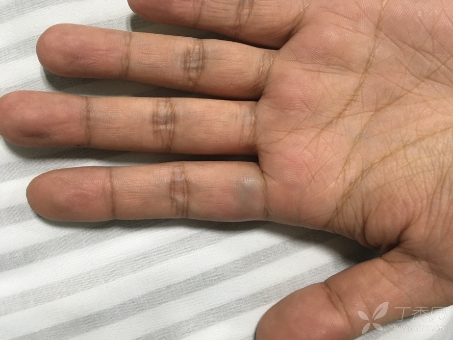 左手食指血管瘤一例 [病例帖]