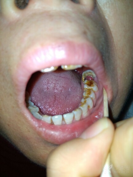 口腔牙龈息肉图片图片