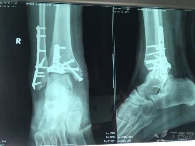 什么是单纯性骨折 3243854454245081237-16w.jpg!w640