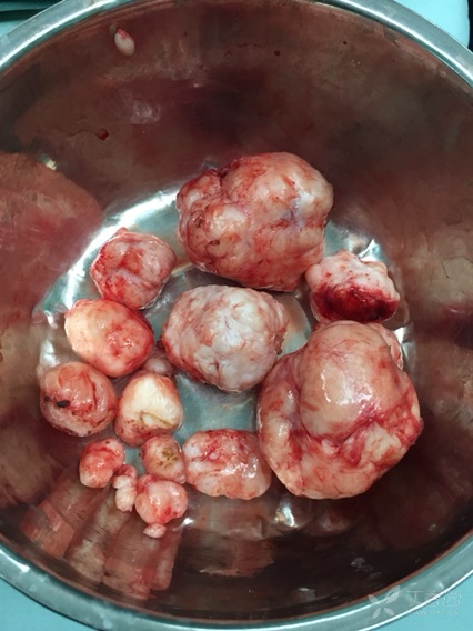 女,48岁,体检发现子宫肌瘤5年,月经量多6个月.要求保留子宫.术中见图.