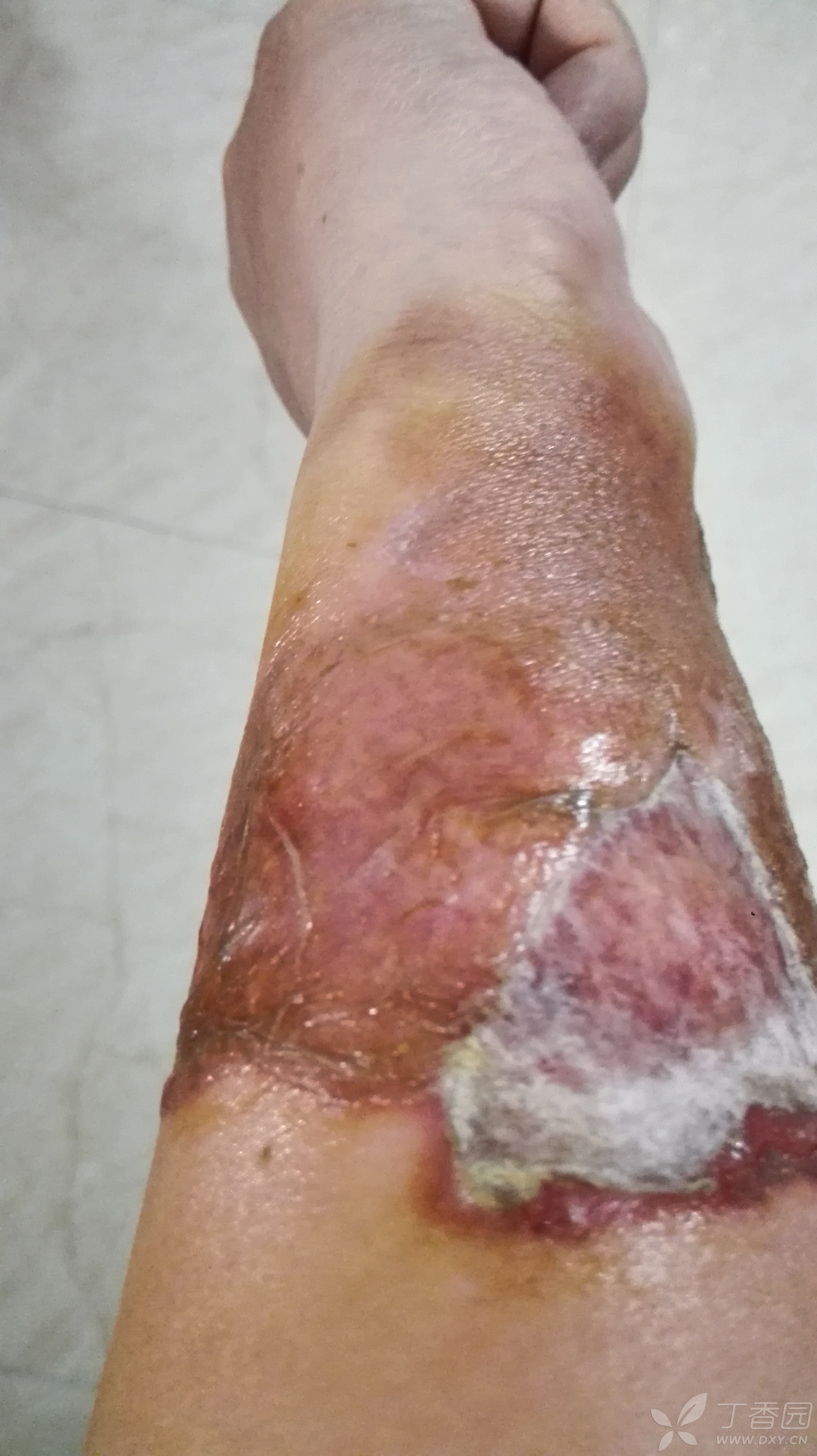 面汤烫伤右前臂,第19天了,啥时候新皮能长全?