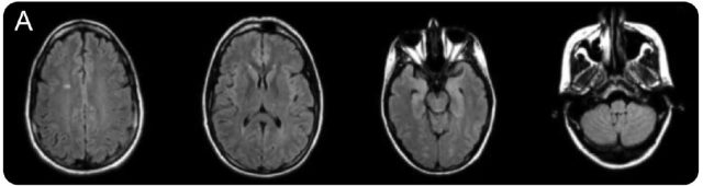 从一个病例学习双侧脑白质病变的鉴别诊断 神经科学专业讨论版 丁香园论坛