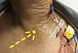 颈内置管后皮下血肿：还能经导管化疗吗？