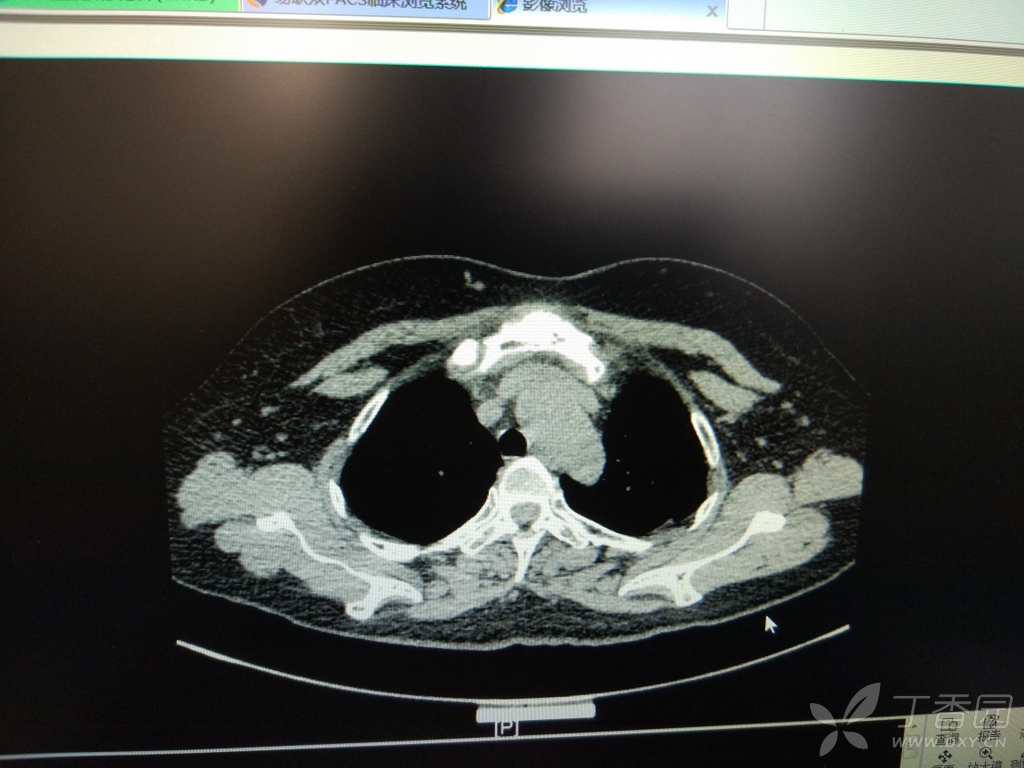 胸锁关节ct扫描范围图片
