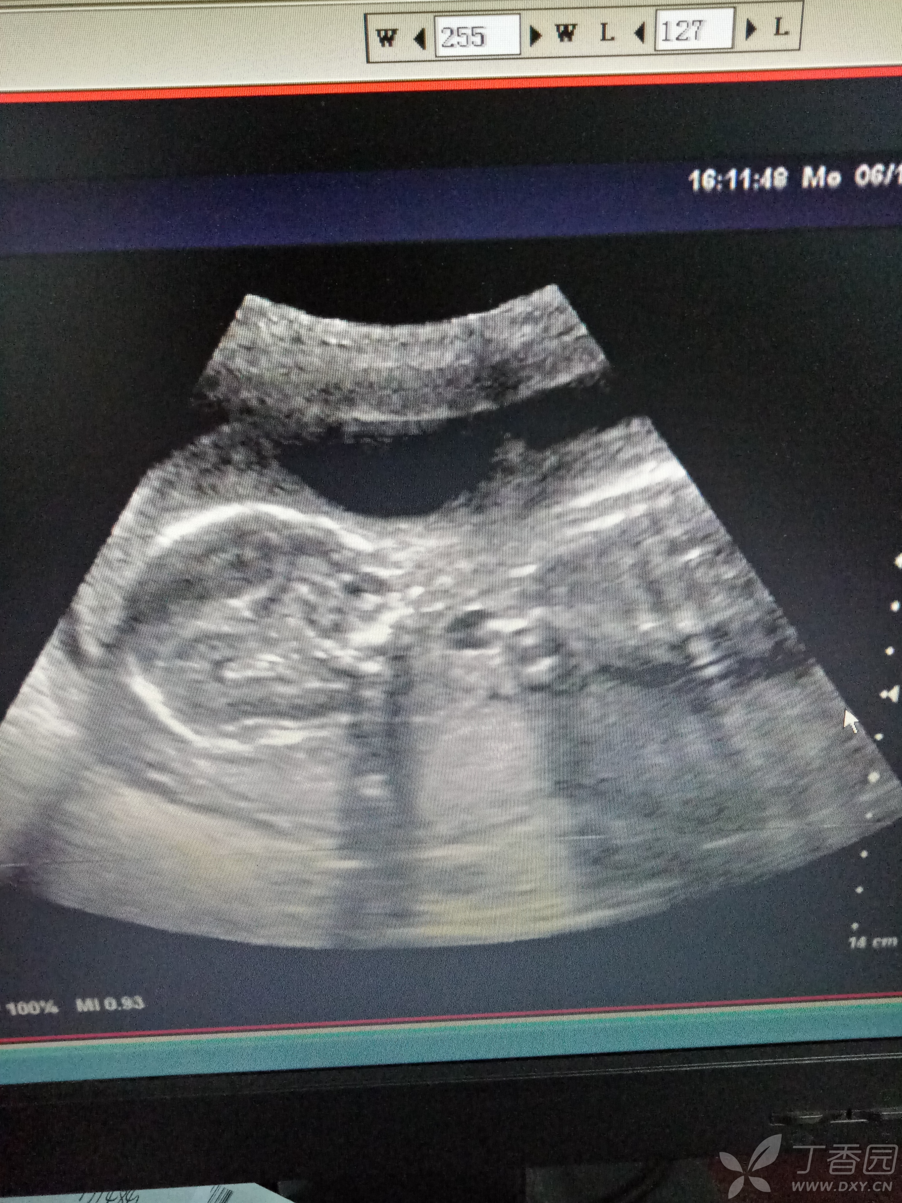 胎儿颈部淋巴水囊瘤图片