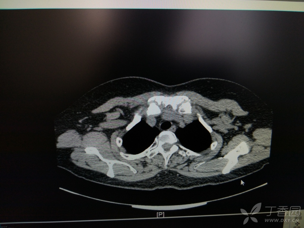 胸锁关节,胸骨柄区病变影像诊断专题讨论 [精华]