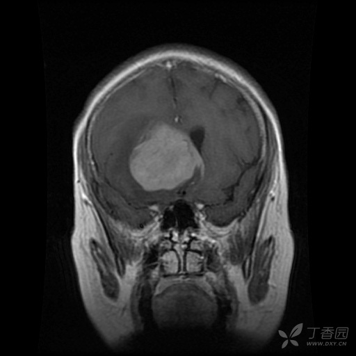 典型颅内占位 [病例帖]