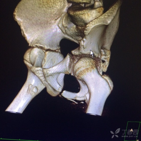 坐骨支骨折图片
