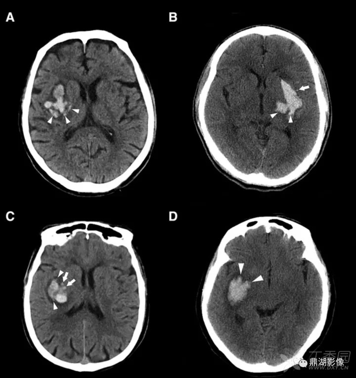 腻害了!李琦岛征:国际上首次以中国人名字命名脑血管疾病征象