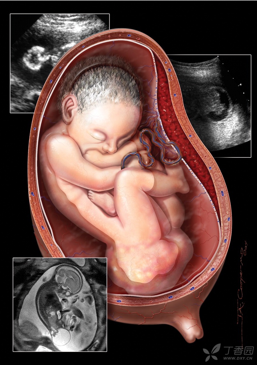 胎儿骶尾部畸胎瘤图片图片