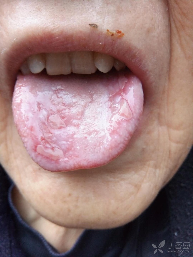 舌头苔癣早期图片图片