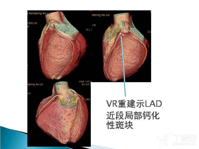 胸痛三联征