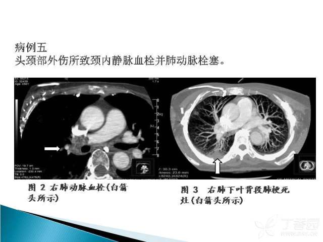 胸痛三联征