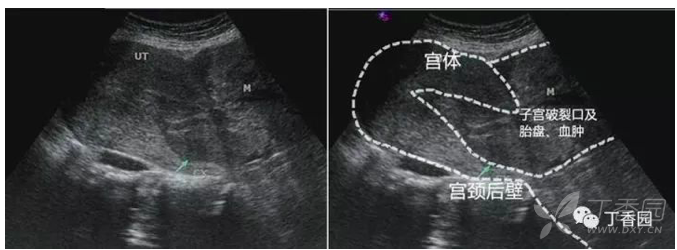 急诊接到一个孕妇 腹中胎儿竟然已经支离破碎 危重急救 丁香园论坛