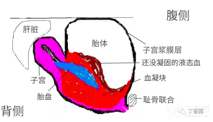 破出子宫的胎体示意图(矢状面) 峡部增大处可见紫蓝色淤血块,仅浆膜层